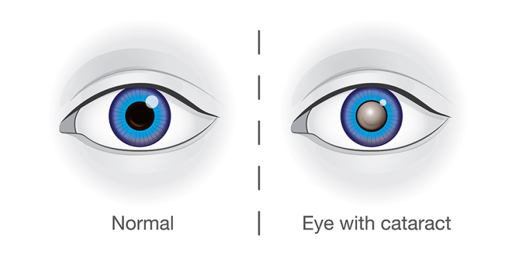 Optometrists: Your First Line Of Defense Against Cataracts