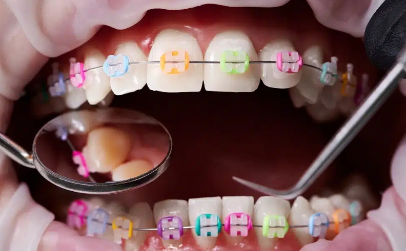 3 Signs It’s Time To See An Orthodontist